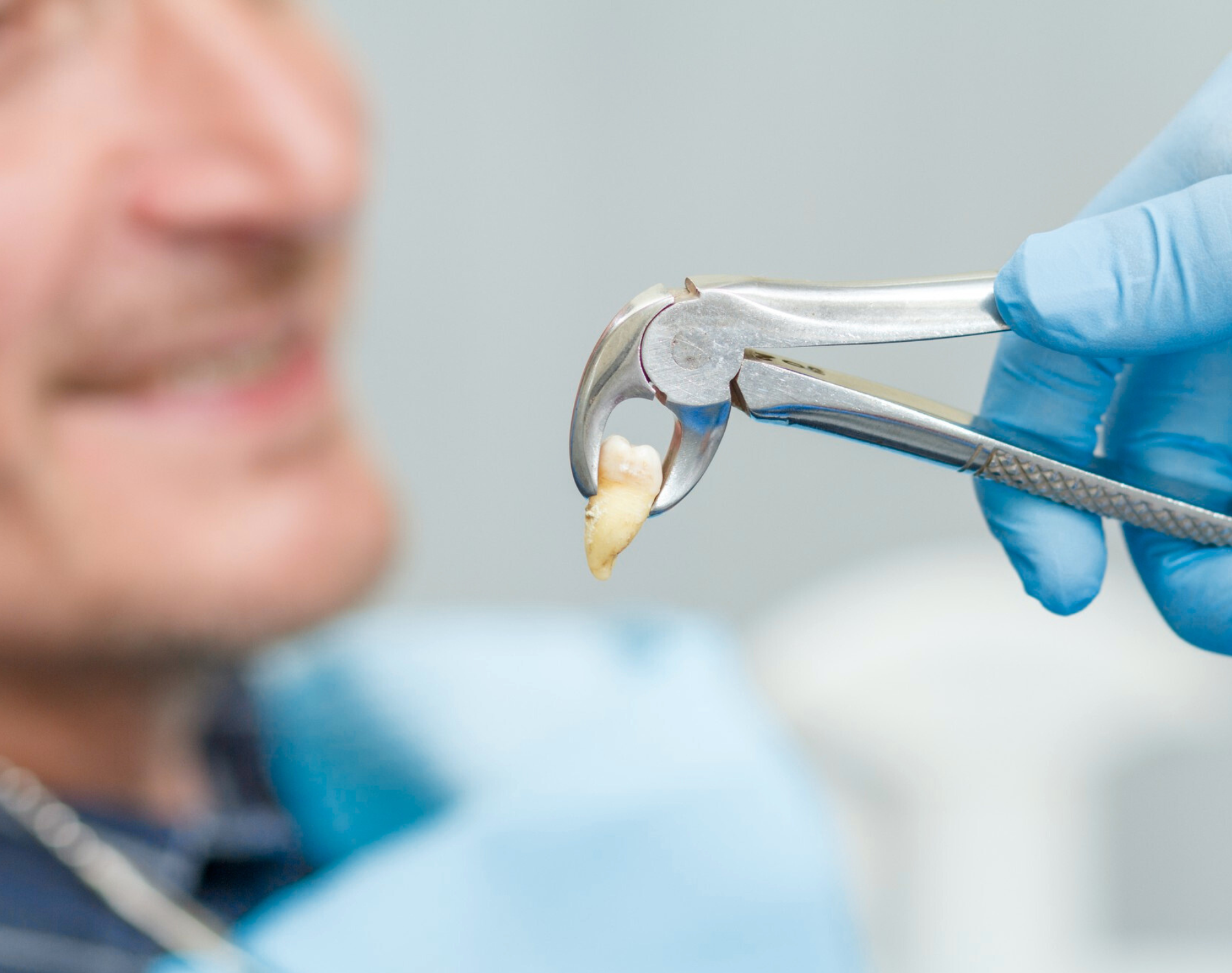 Tooth Extractions