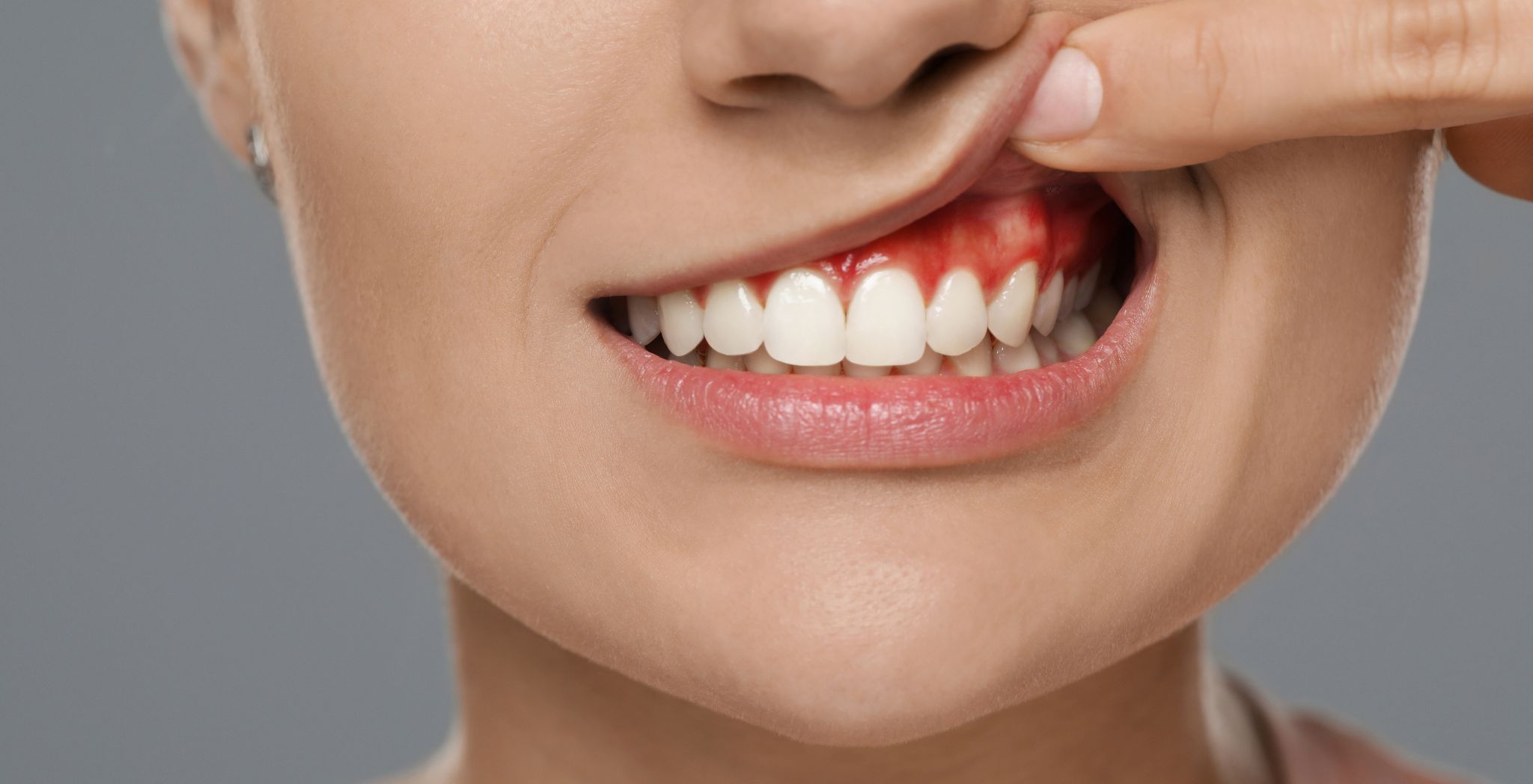 Tooth Abscess