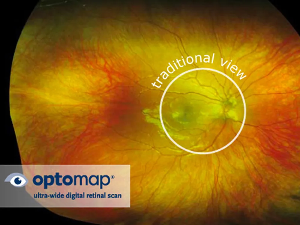 Optomap ultra-wide retinal scan compared to the traditional exam view