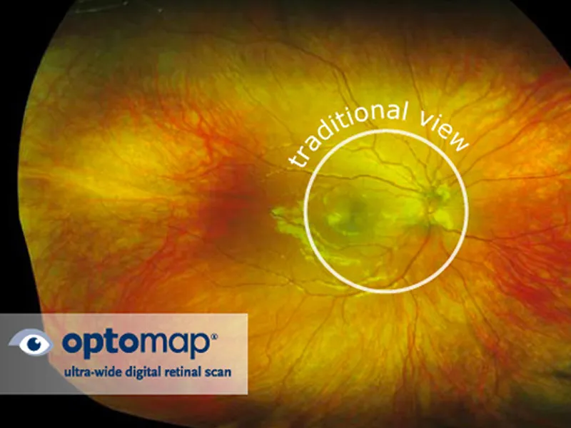 Optomap ultra-wide retinal scan comparing the wider field of view to a traditional view