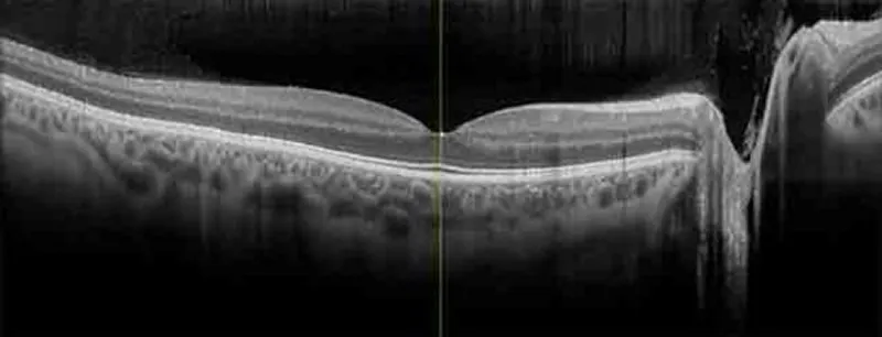 OCT retinal scan showing a cross-section of the retina layers and macula