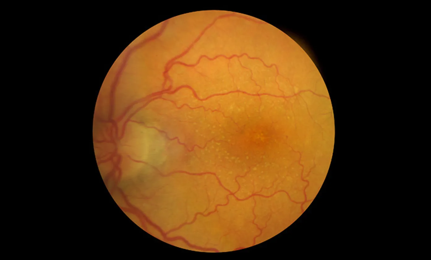 Close-up view of a human retina showing blood vessels and the macula area in orange tones.