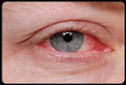 Optometrist offers advice to hayfever sufferers