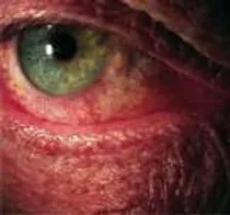Sheffield Optometrist extends services with Dry Eye treatment