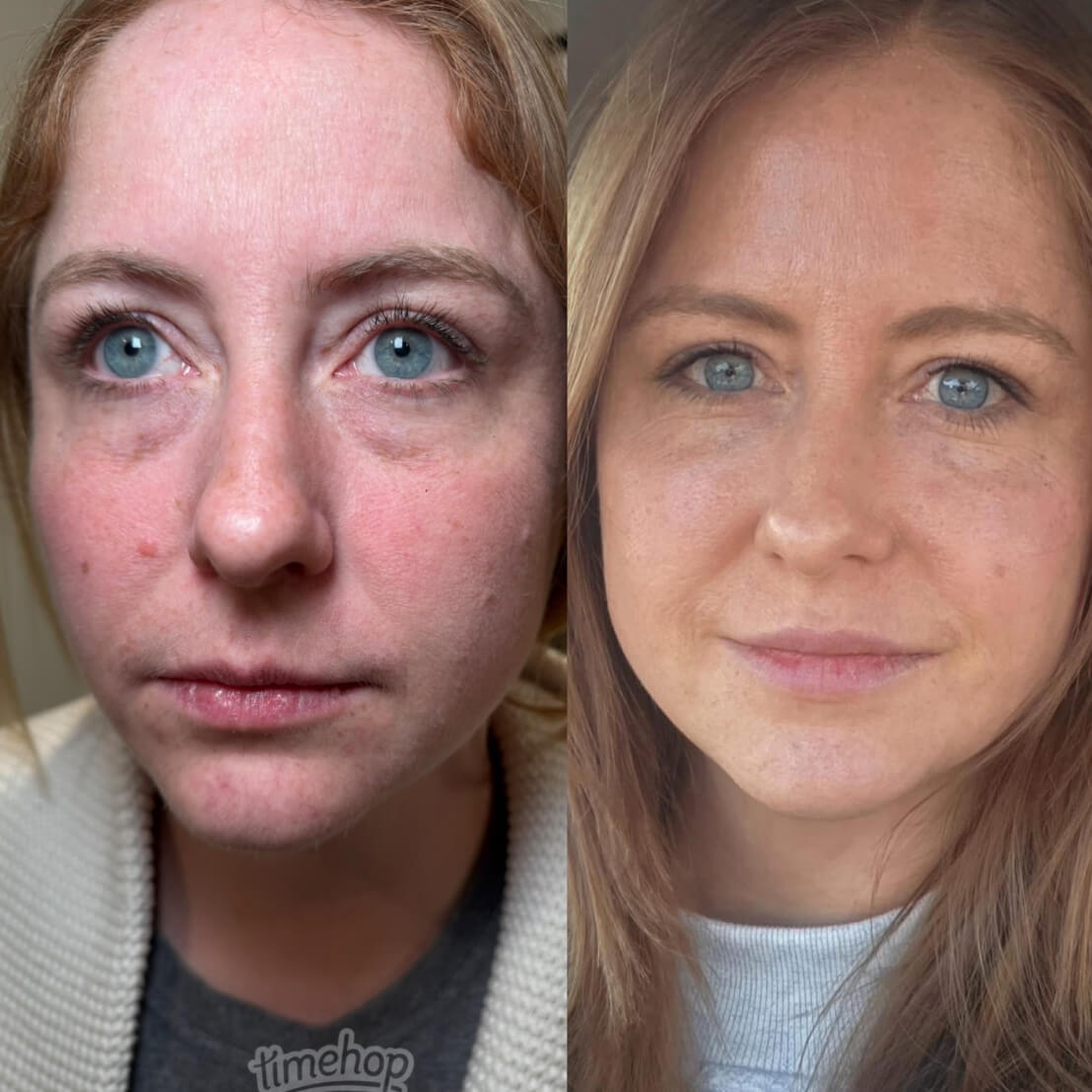 Side-by-side close-up portraits of a woman showing facial skin improvement, with red and patchy complexion on the left and clearer, smoother skin on the right.