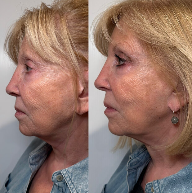 Aviva facial treatments before and after result
