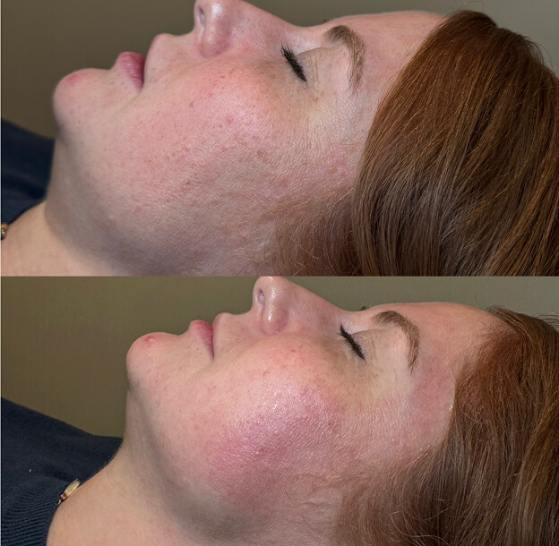 Aviva facial treatments before and after result