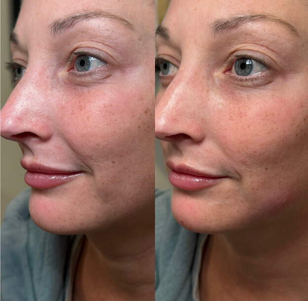 Aviva facial treatments before and after result
