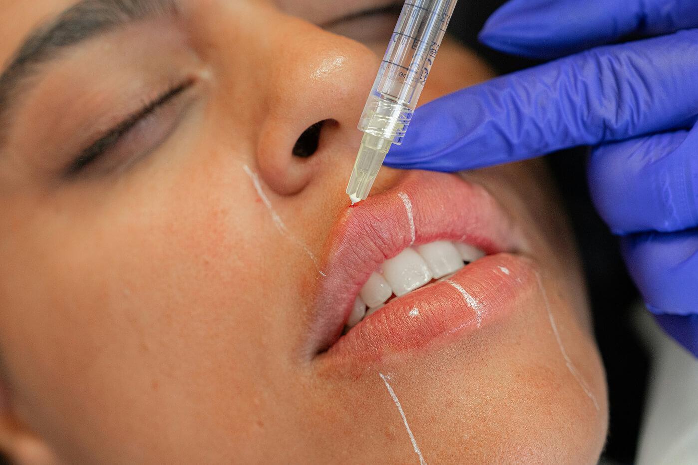 Close-up of a practitioner injecting lip filler with precise technique, highlighting how depth and placement affect results