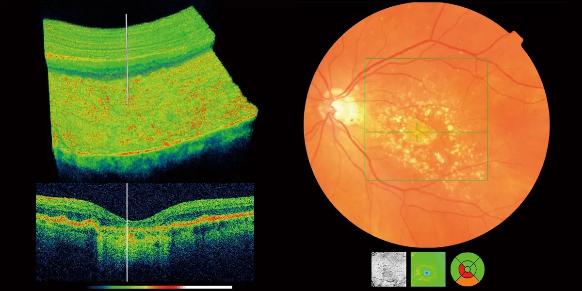 OCT scan images showing detailed cross-sections and color map of the macula and retina.