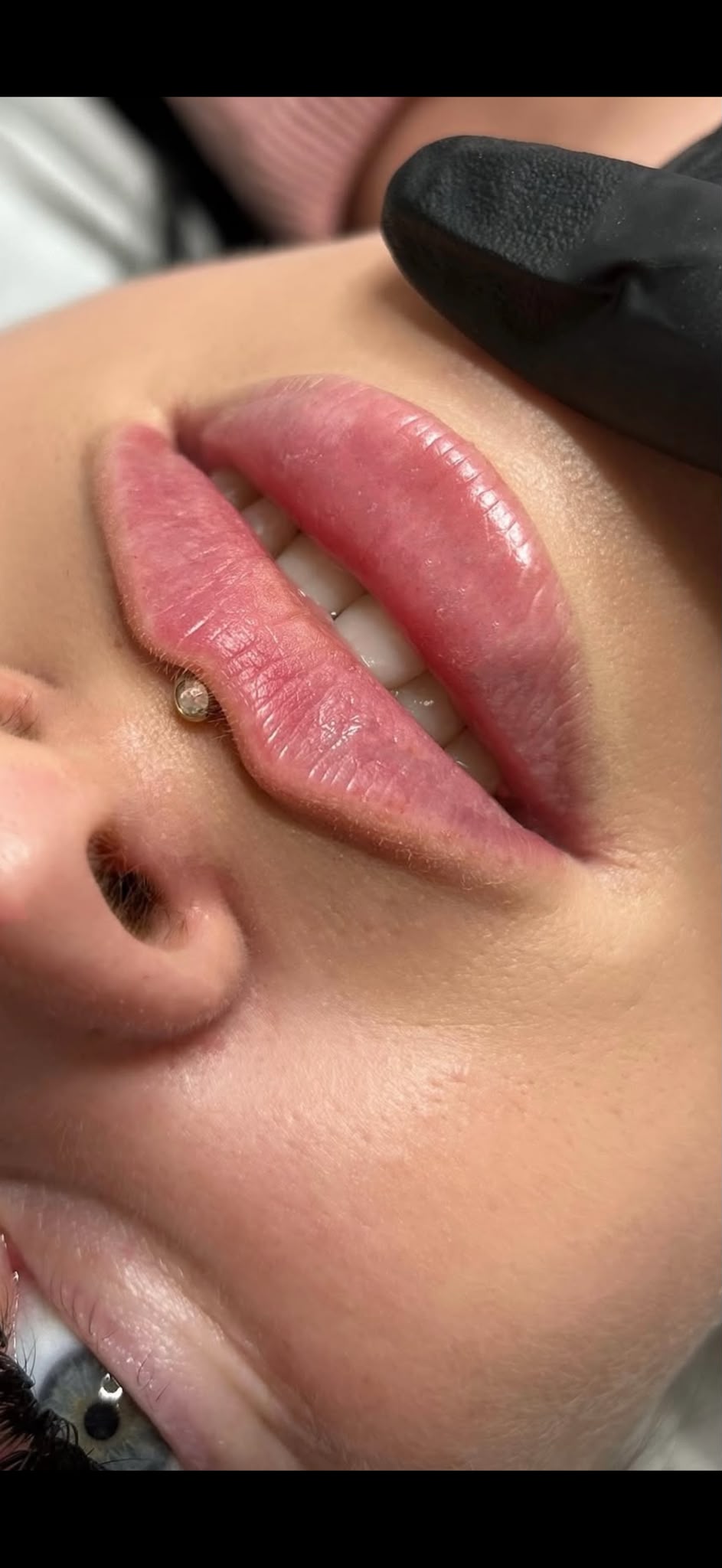 Lippenaufbau bei VIP Ästhetics