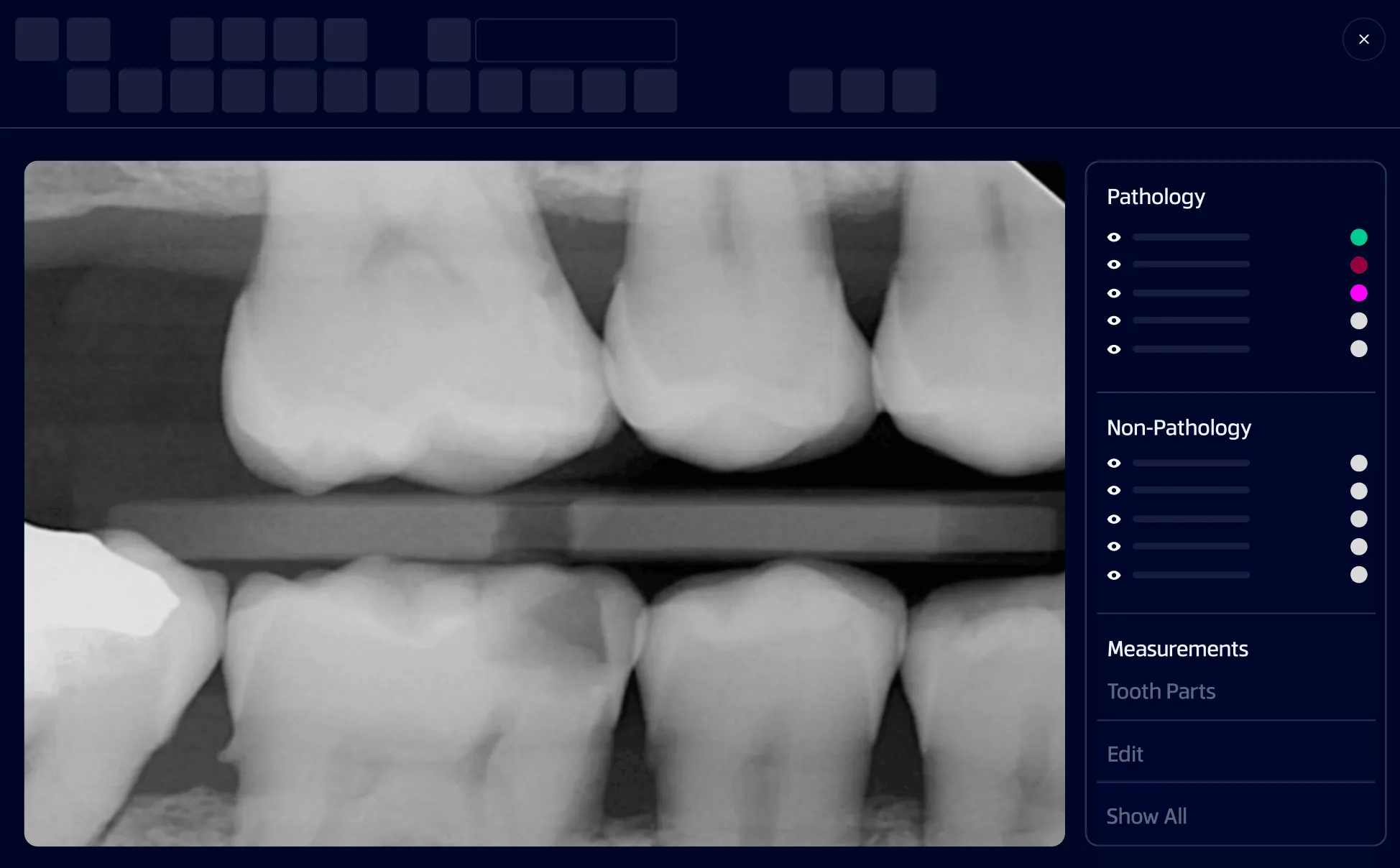 Dental X-ray image showing several teeth and a bitewing film holder, with a sidebar listing pathology, non-pathology, and measurement options.