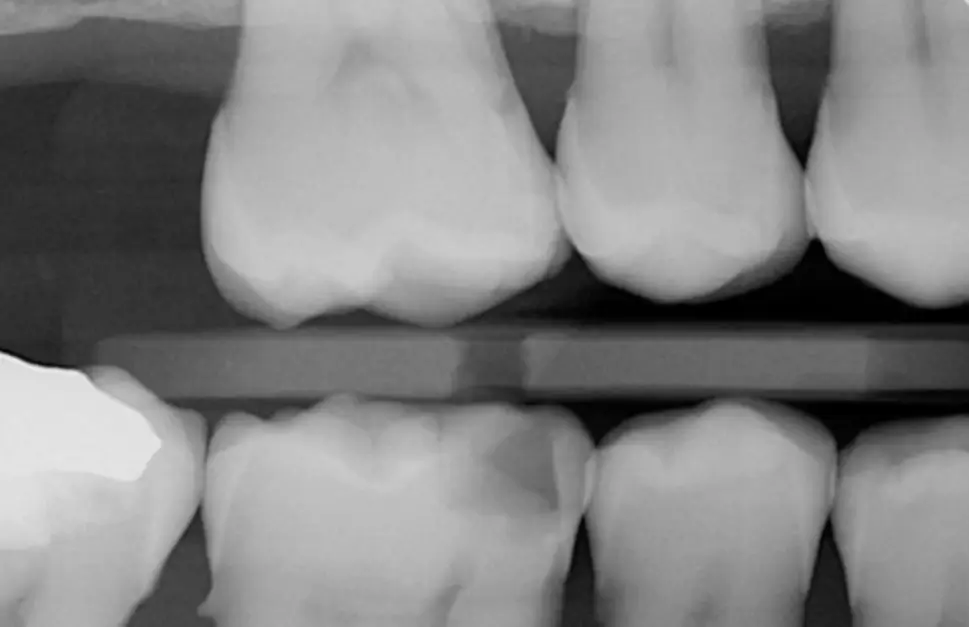 Dental X-ray showing several molars with a dental instrument between the upper and lower teeth.