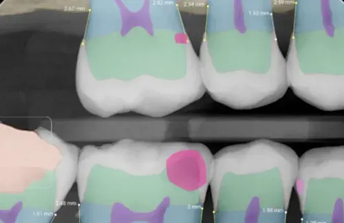 Dental X-ray image showing multiple teeth with color-coded regions and measurements in millimeters.
