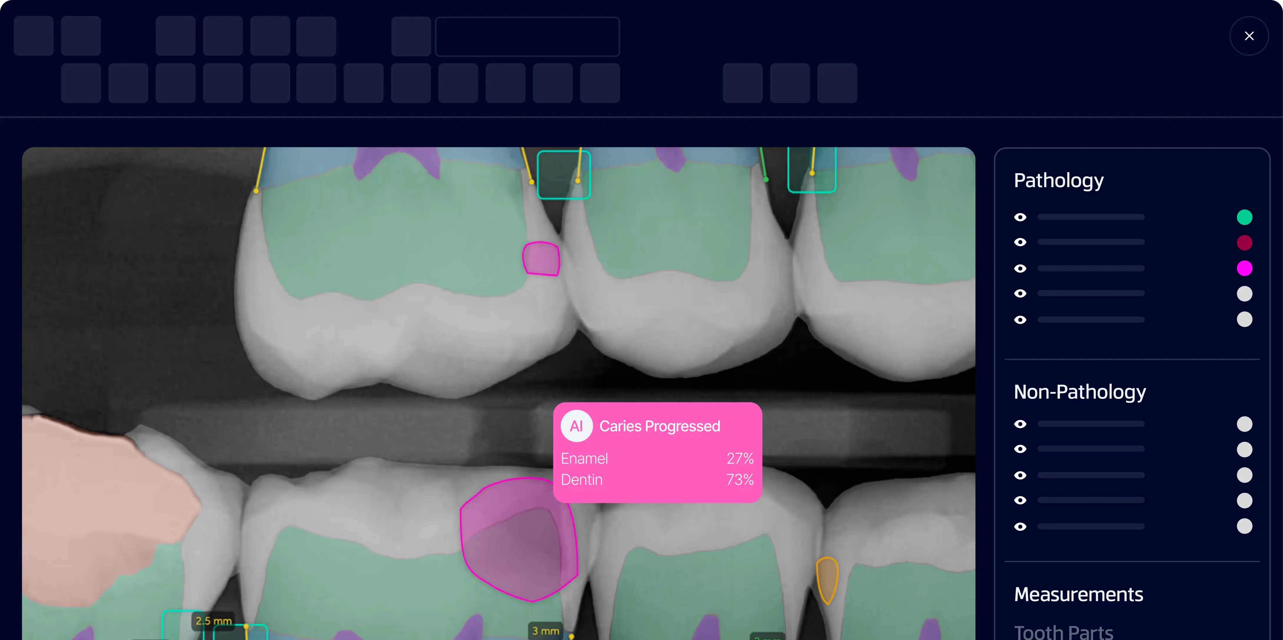 Dental X-ray showing teeth with AI-detected caries progression marked in pink, indicating 27% enamel and 73% dentin involvement.