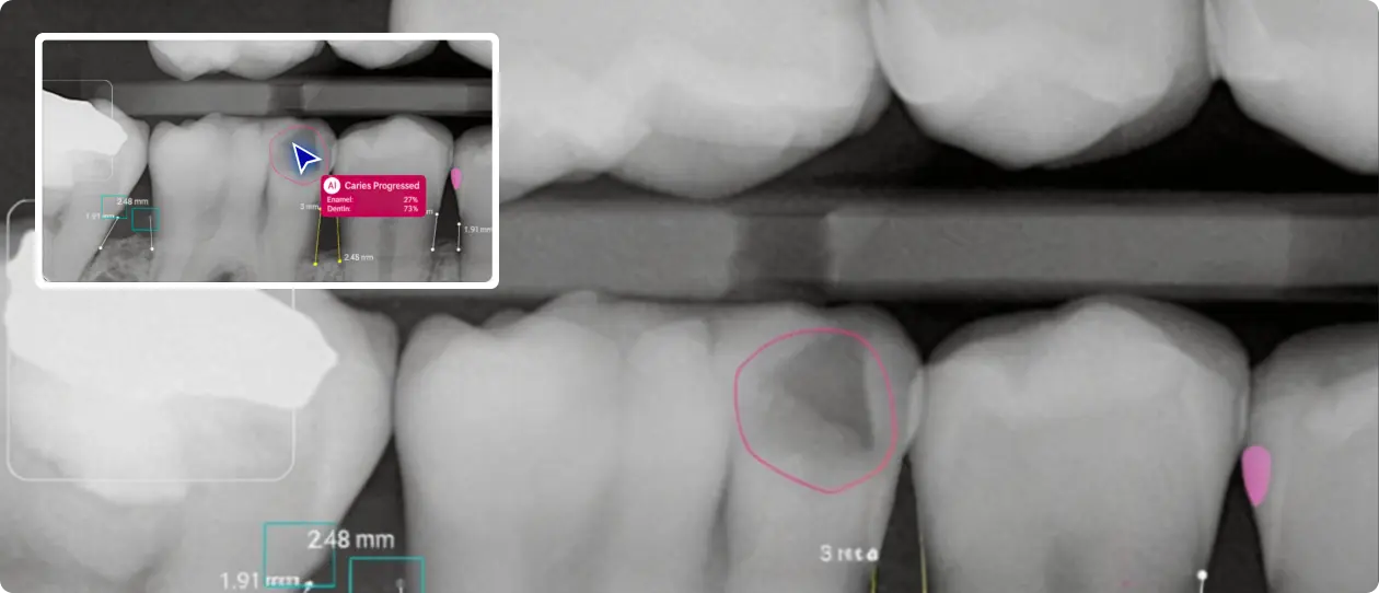 Dental X-ray showing molars with a highlighted area indicating progressed caries on one tooth enamel and dentin with measurements.