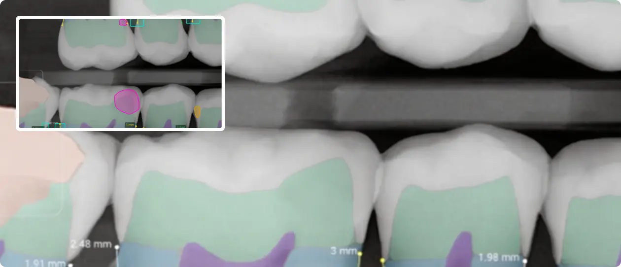 Dental X-ray image with color-coded annotations highlighting measurements and areas on molar teeth for dental analysis.