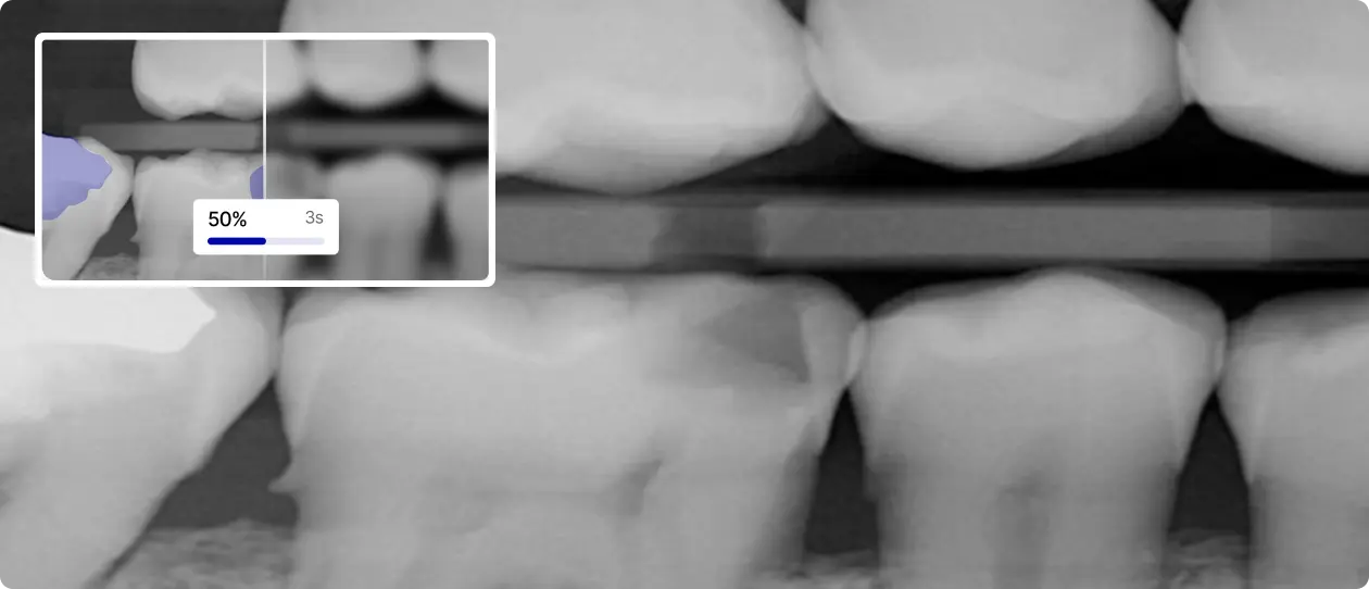 Dental X-ray image showing close-up of several teeth, highlighting one tooth with a loading bar overlay indicating 50% completion.
