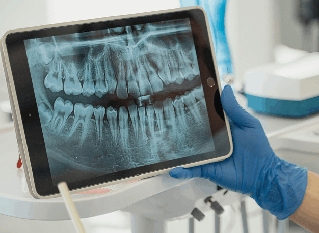 Dental professional wearing blue gloves holding a tablet displaying a panoramic dental X-ray image.