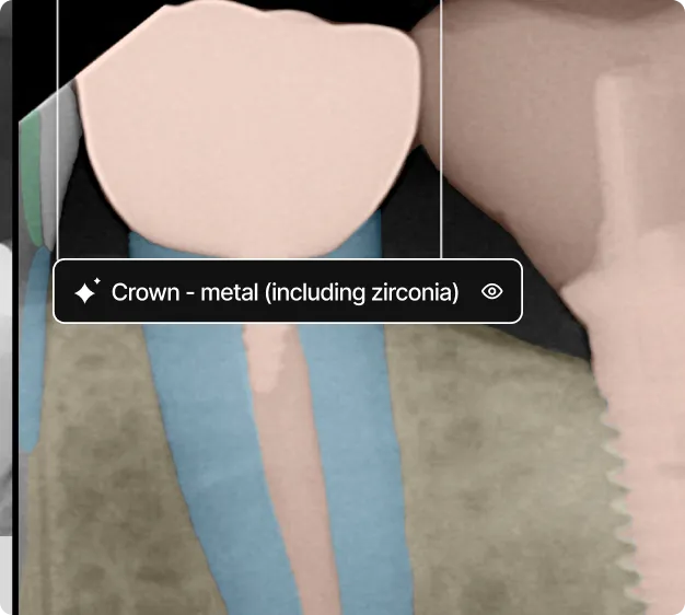 Dental X-ray highlighting a metal crown, including zirconia, on a tooth.
