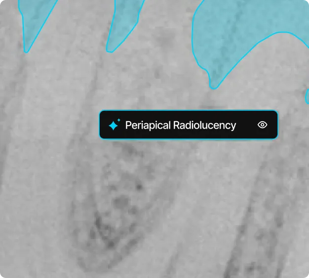 Dental X-ray showing a tooth with an area labeled as Periapical Radiolucency indicating a dark spot near the root tip.