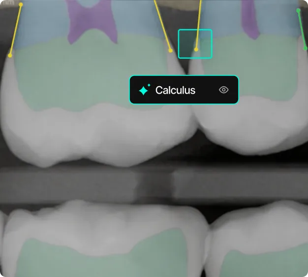 Close-up dental X-ray image showing calculus buildup highlighted on two adjacent molars.