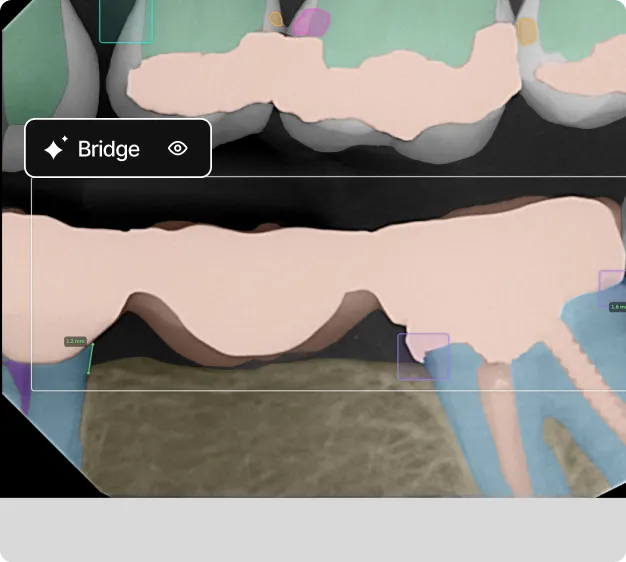 Digital dental scan showing a 3D model of a dental bridge in place between molars with measurements.
