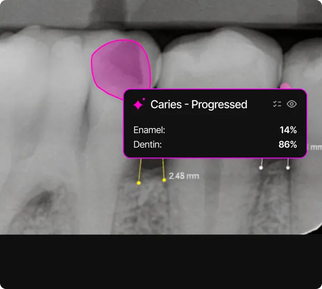 Dental X-ray showing a molar with a highlighted progressed caries lesion affecting 14% enamel and 86% dentin.