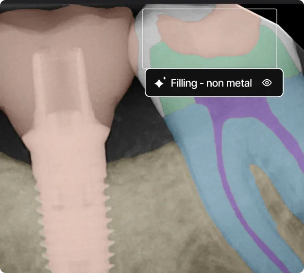Dental X-ray showing a dental implant on the left and a tooth with colored segments indicating root canals and a non-metal filling on the right.