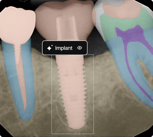 Dental X-ray highlighting a dental implant screw placed between two natural molars, with labeled color-coded tooth anatomy.