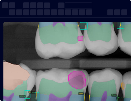 Dental X-ray image showing teeth with highlighted areas in green and purple, indicating measurements and possible dental analysis.
