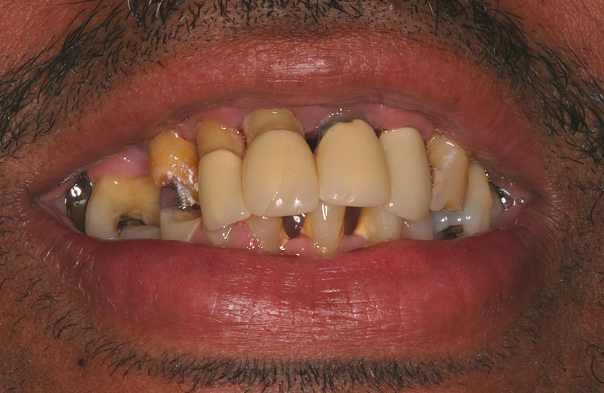 Close-up of a mouth with severely damaged and decayed teeth, some with visible dental crowns and cavities.