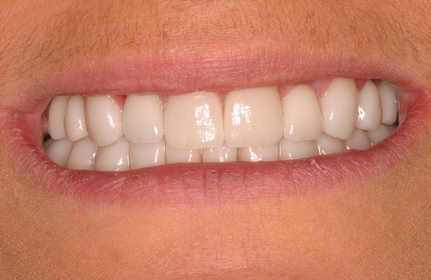 Close-up of a slight smile showing well-aligned, white teeth with healthy gums.