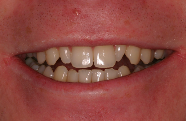 Close-up of a person's smile showing slightly misaligned and unevenly spaced teeth with natural coloration.