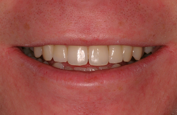 Close-up of a person’s smile showing upper front teeth and slightly parted lips.