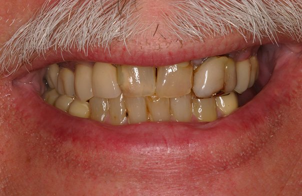 Close-up of an elderly person's mouth showing stained and worn teeth with a white mustache above the lips.