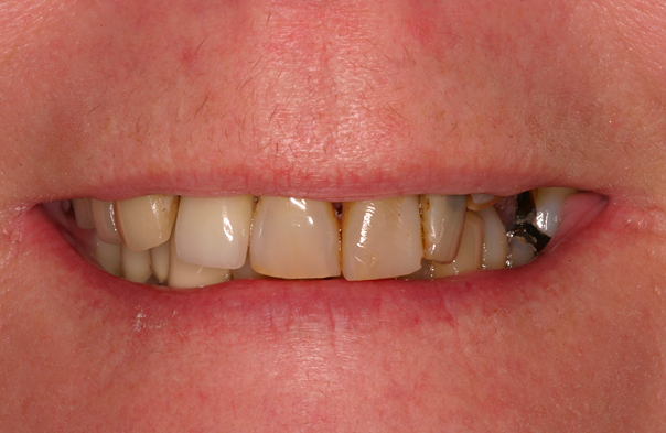 Close-up of a person's teeth showing discoloration, plaque buildup, and dental restorations.
