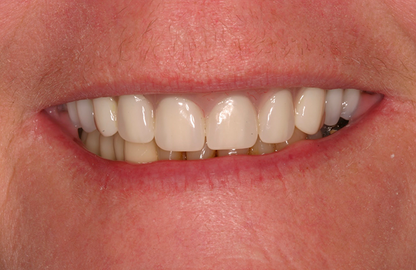 Close-up of a person's mouth showing a smile with clean, white teeth and visible dental crowns on front teeth.