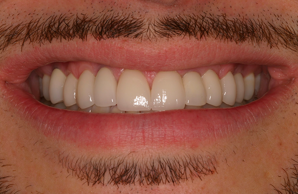 Close-up of a smiling mouth showing upper and lower teeth with facial hair above and below the lips.