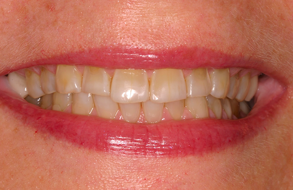 Close-up of a person smiling with slightly discolored and uneven teeth.