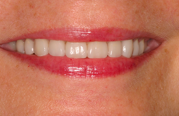 Close-up of a person's smile showing clean, aligned teeth and pink lips.