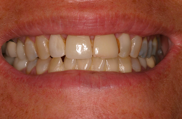 Close-up of a person's slightly clenched teeth with visible discoloration and wear.