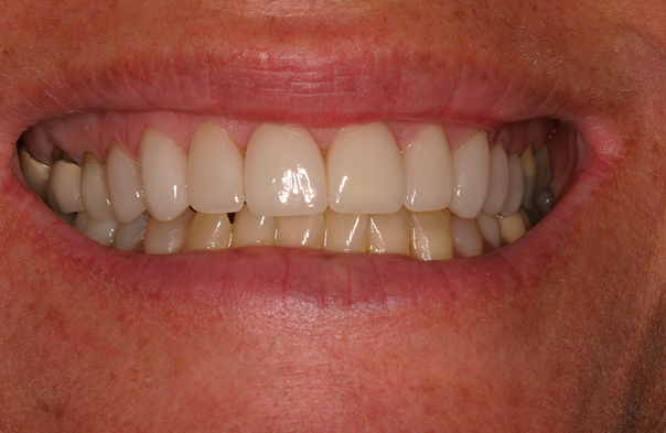 Close-up of a person's smile showing upper and lower teeth with visible dental restorations on the upper teeth.