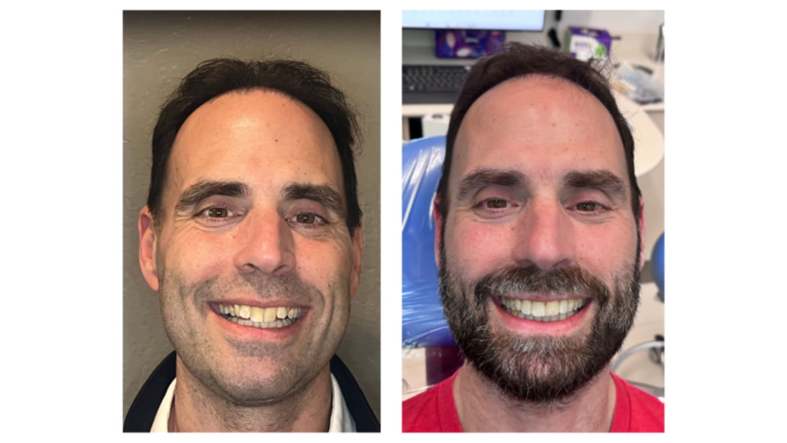 Invisalign Before & After #2.png