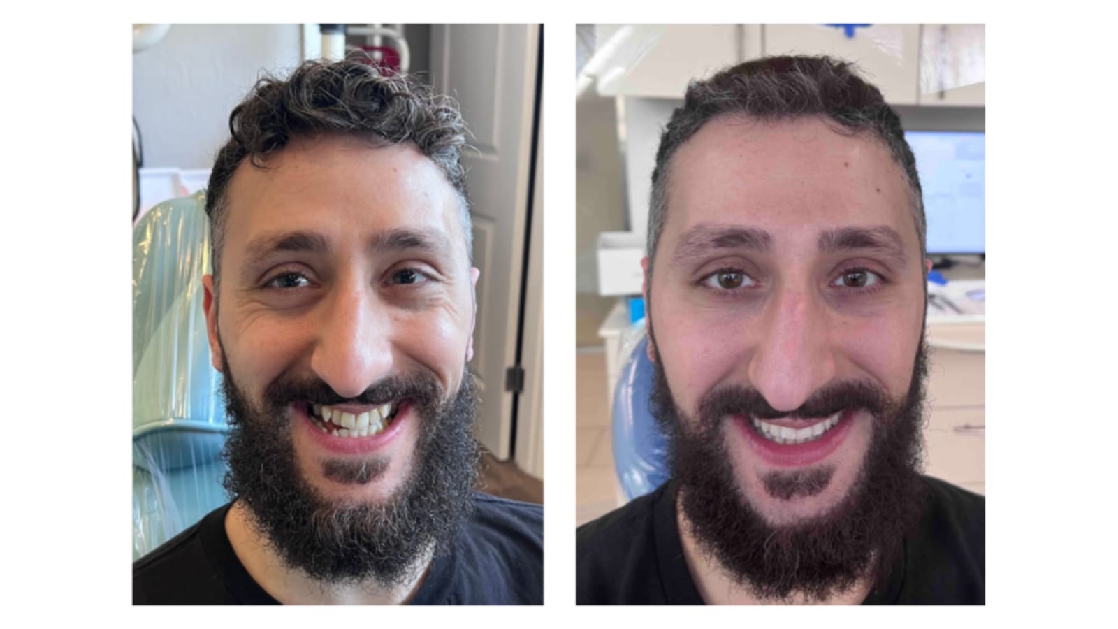 Invisalign Before & After #3.png