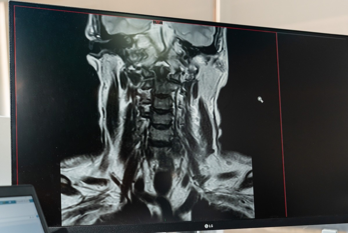 Imagen de resonancia magnética que muestra una vista coronal del cuello y la columna cervical en la pantalla de un monitor.