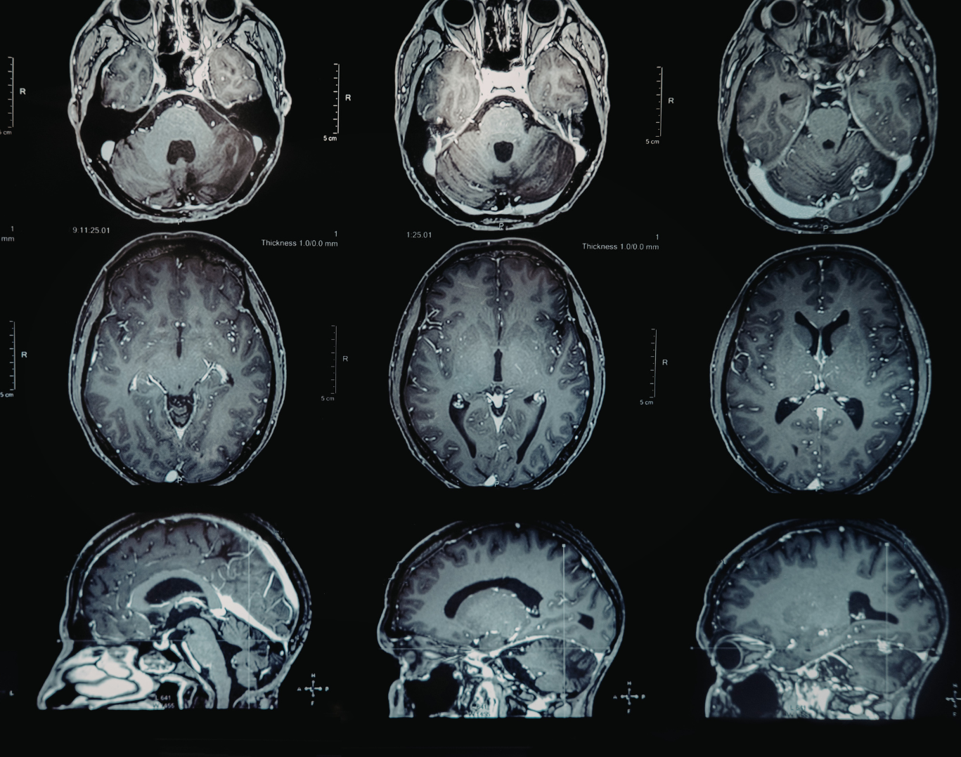 Nueve imágenes de resonancia magnética cerebral distribuidas en tres filas que muestran vistas axiales y sagitales de la anatomía y las estructuras del cerebro.
