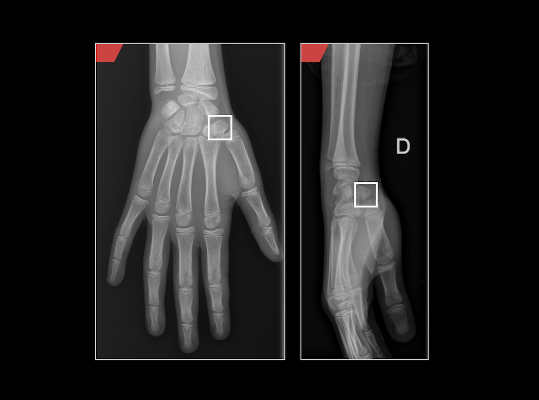 Radiografías de la mano izquierda y la muñeca, con cuadrados blancos que resaltan la zona del hueso escafoides.