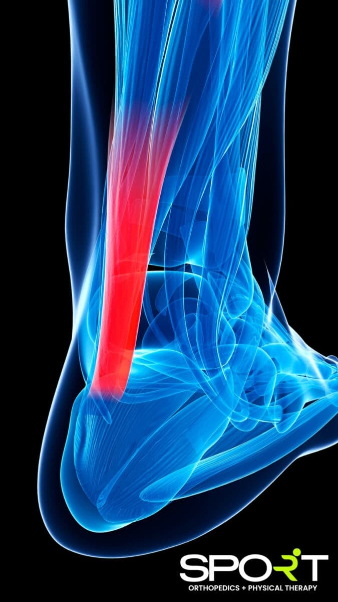 achilles tendonitis