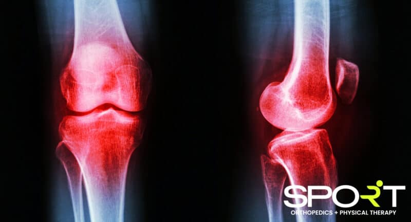 patellar subluxation dallas